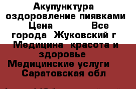 Акупунктура, оздоровление пиявками › Цена ­ 3 000 - Все города, Жуковский г. Медицина, красота и здоровье » Медицинские услуги   . Саратовская обл.